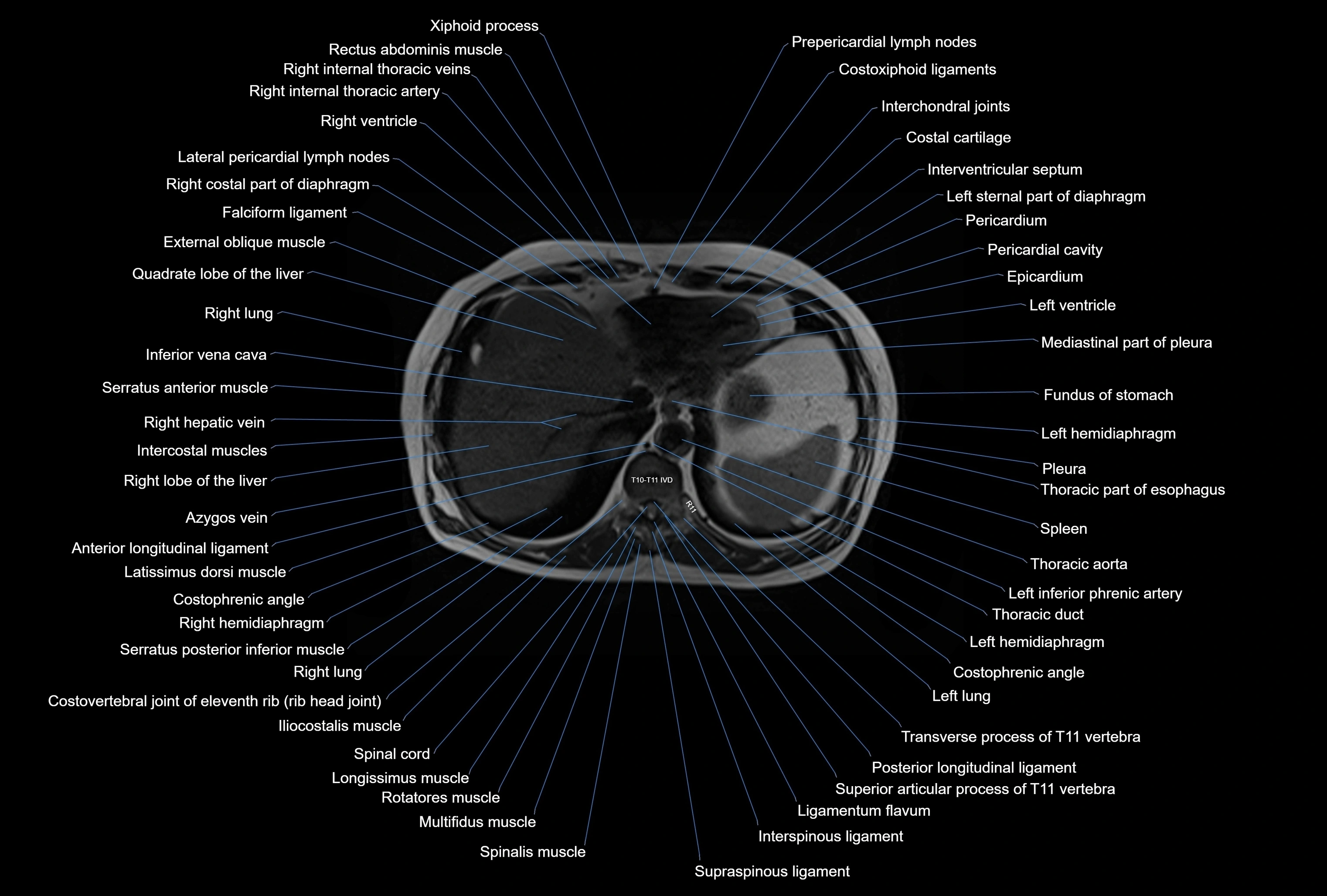 MRI Abdomen axial cross sectional anatomy radiology  image-img-00001-00006.webp